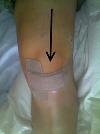 I Took an Arrow in the Knee
